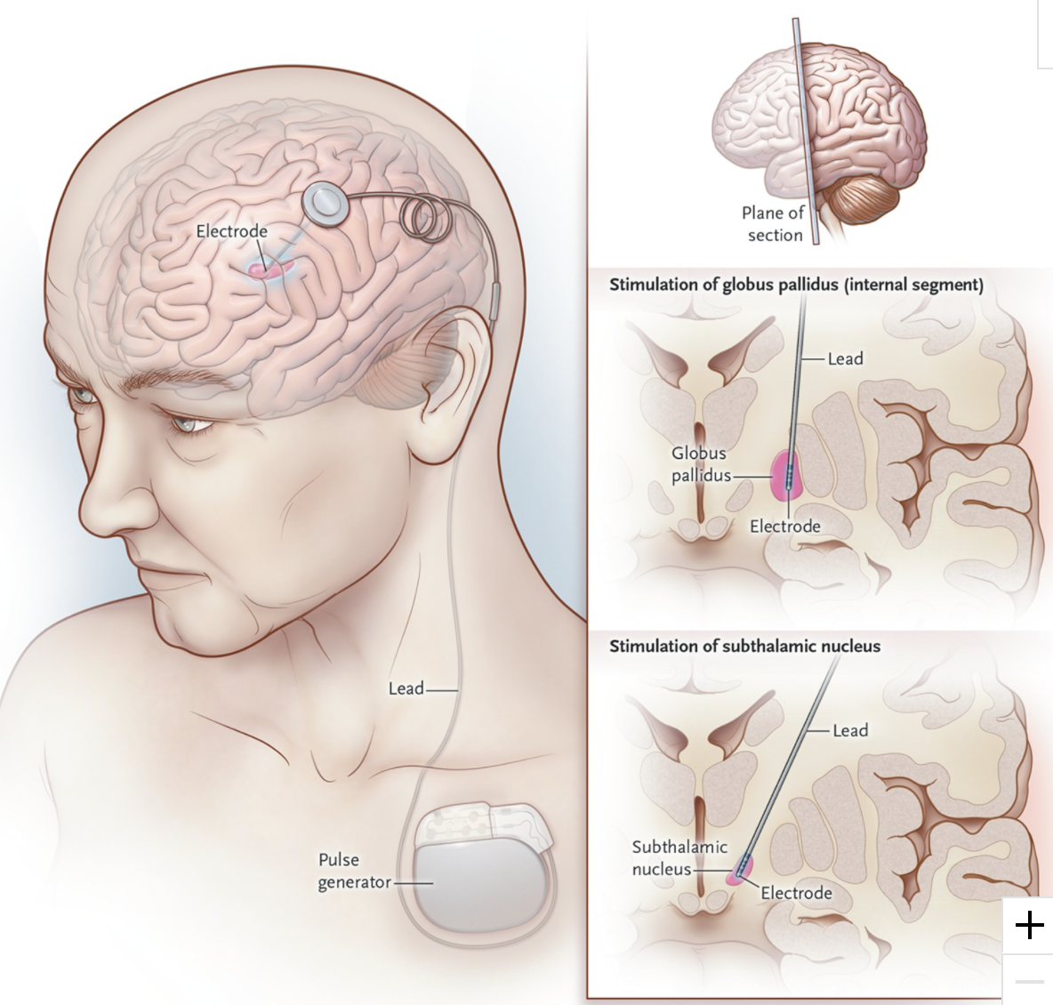 What is all the 'FUS' about with focused ultrasound for